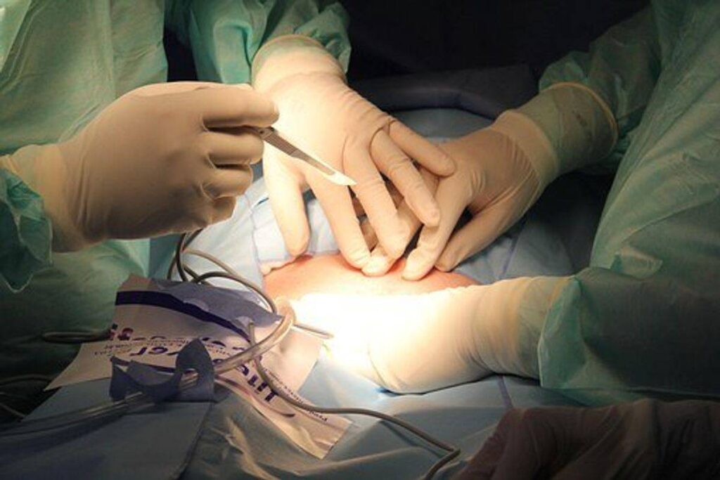 hysterectomy
