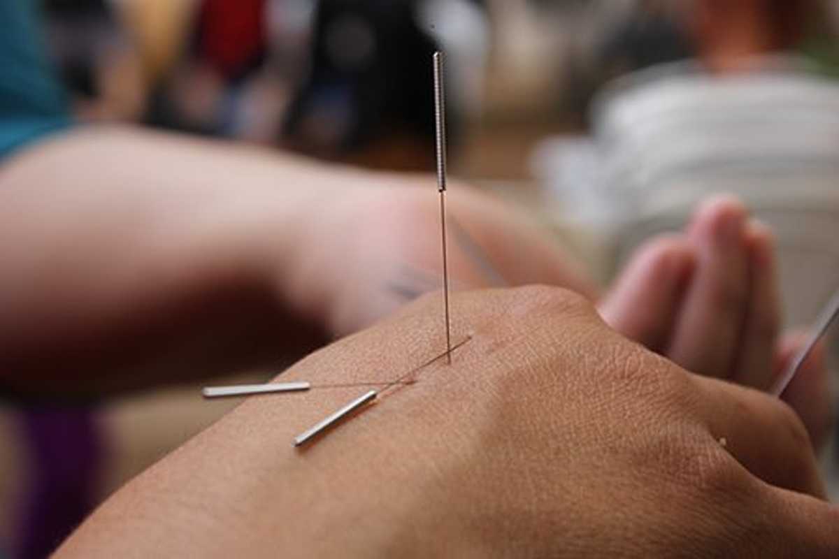 How Old is Acupuncture