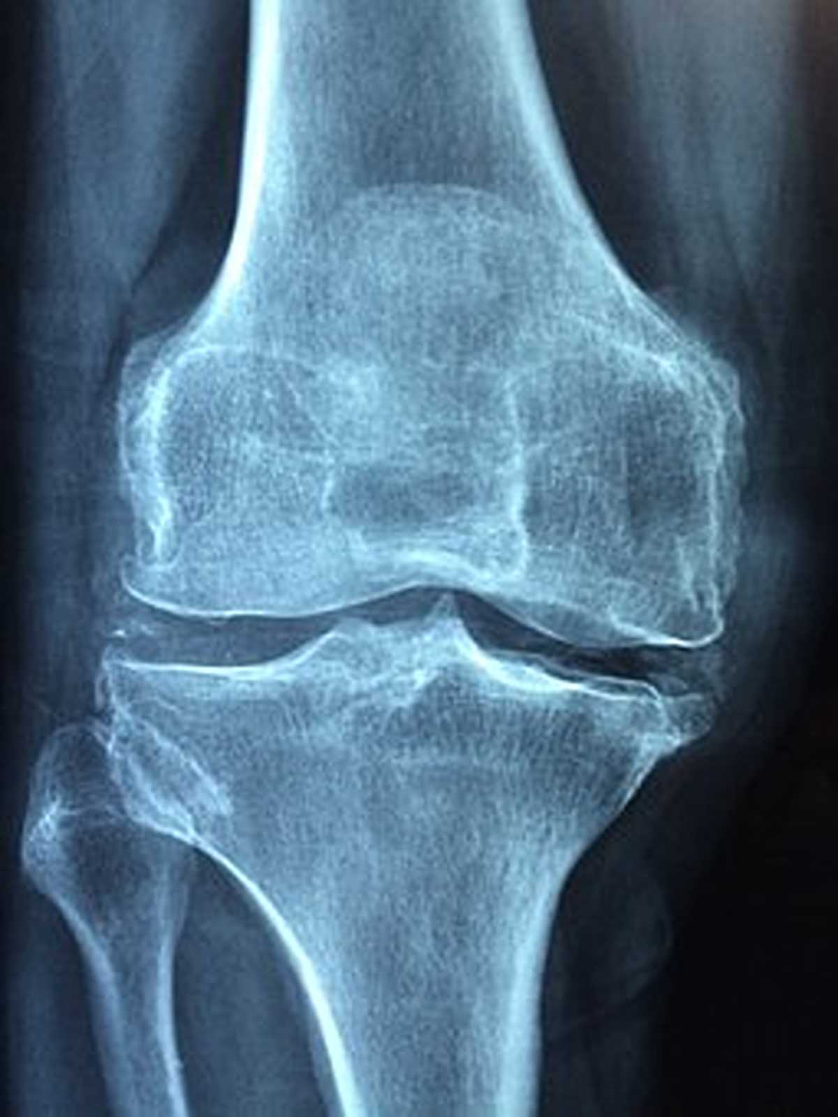 How to Manage Osteoarthritis Pain
