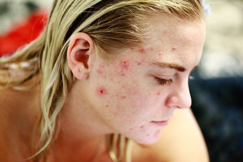 How to Get Rid of Acne Fast